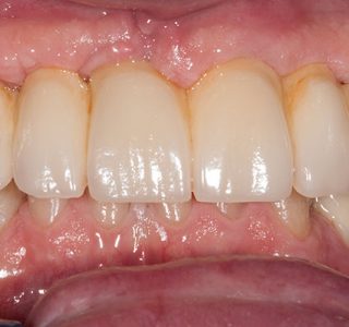 full arch implant case after