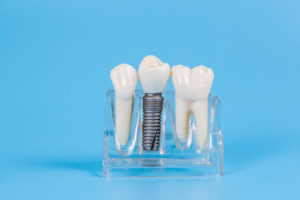 a model of a placed dental implant