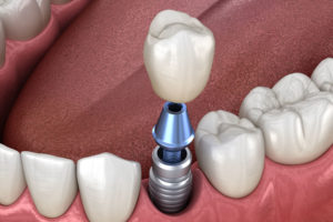 an image of a lower arch of teeth with a single dental implant post in the gum line, the abutment over the implant post, and the dental crown over the abutment.
