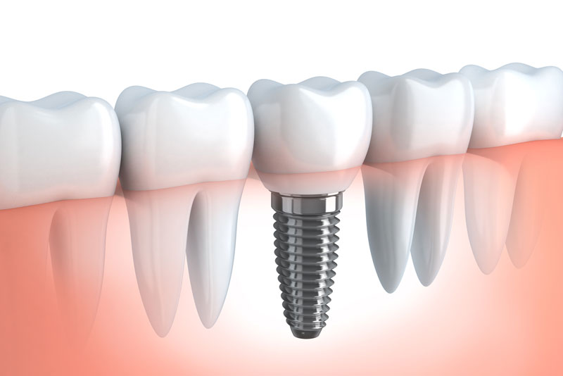 an image of a single dental implant model, that has been placed, using CHROME guidedSMILE implant surgery technology, into transparent gums so the dental implant post is shown. the single dental implant is surrounded by natural teeth.