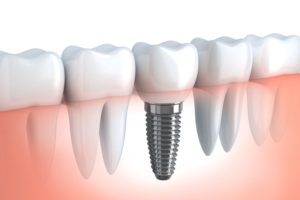 a picture of a dental implant model showing where a prosthodontist can place a dental implant post in between surrounding natural teeth. There is a crown on top of the dental implant post.
