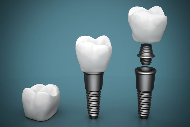 same day dental implants