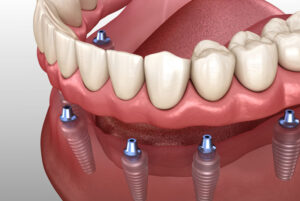 a graphic picture of an implant supported denture model with four dental implants in the jawbone ready to stabilize the denture hovering above them.