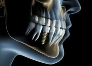 An image of a dental implant x-ray.