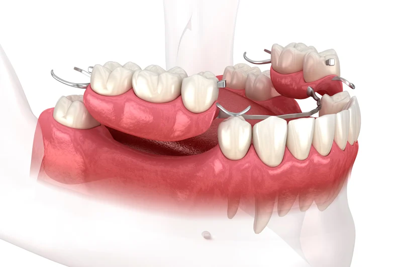 dentalimplant3