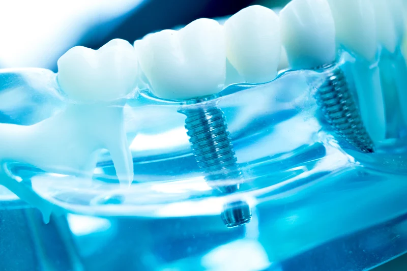 dentalimplants2