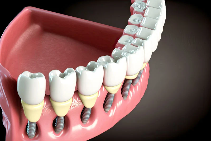 full mouth implants
