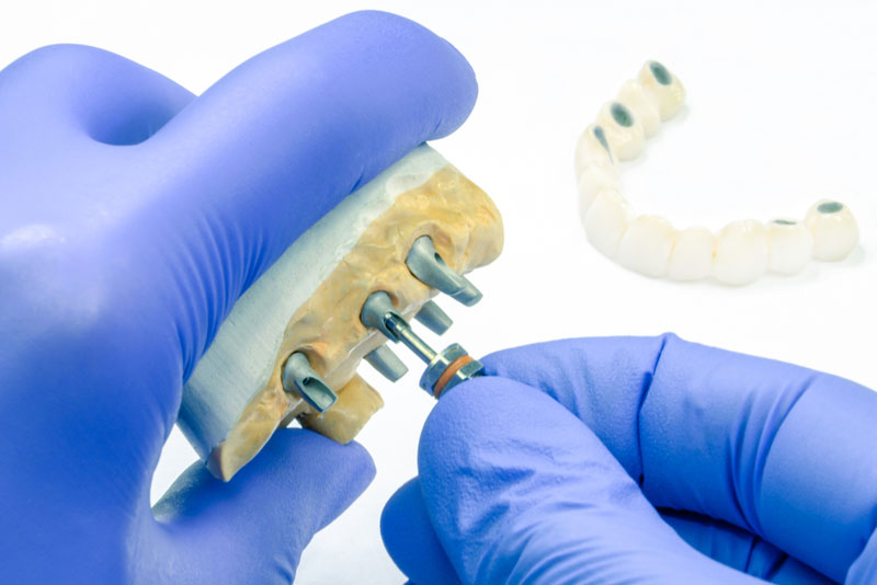 a dental implant model with a dental implant post and screw.