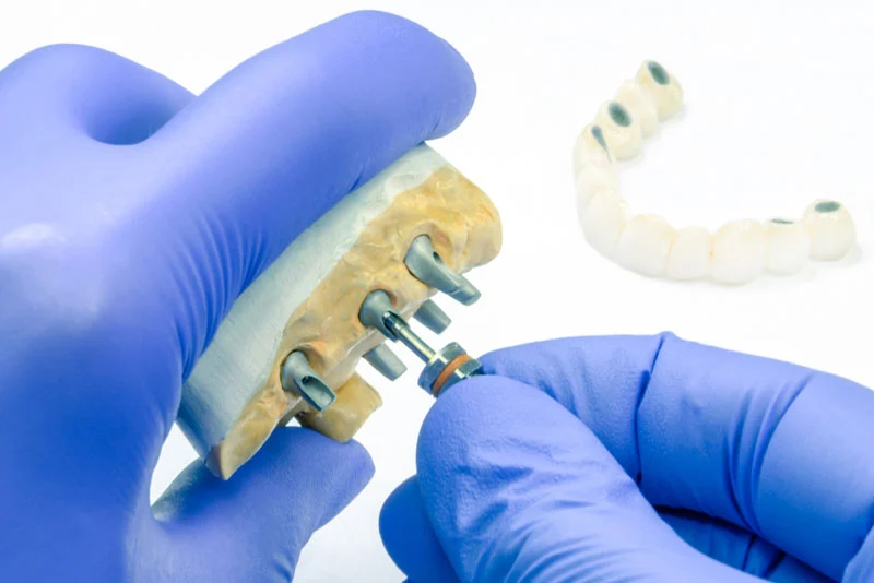 custom dental implant model