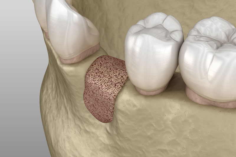 an image of a bone graft model.