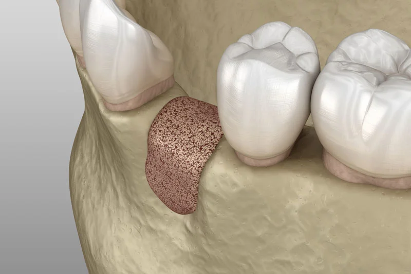 an image of a bone graft model.