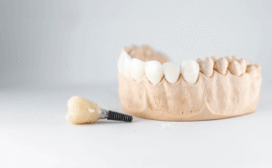 Close-up of dental model with implant. patient of dental clinic on blurred background. dentistry