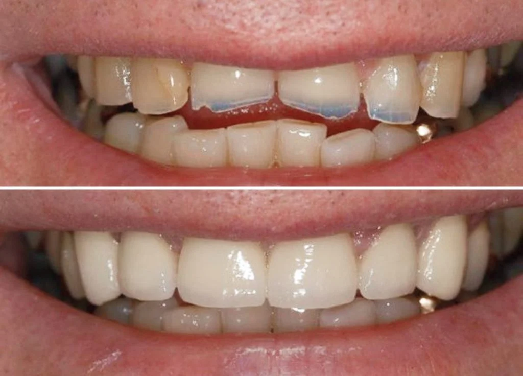 Smile Gallery Single-2