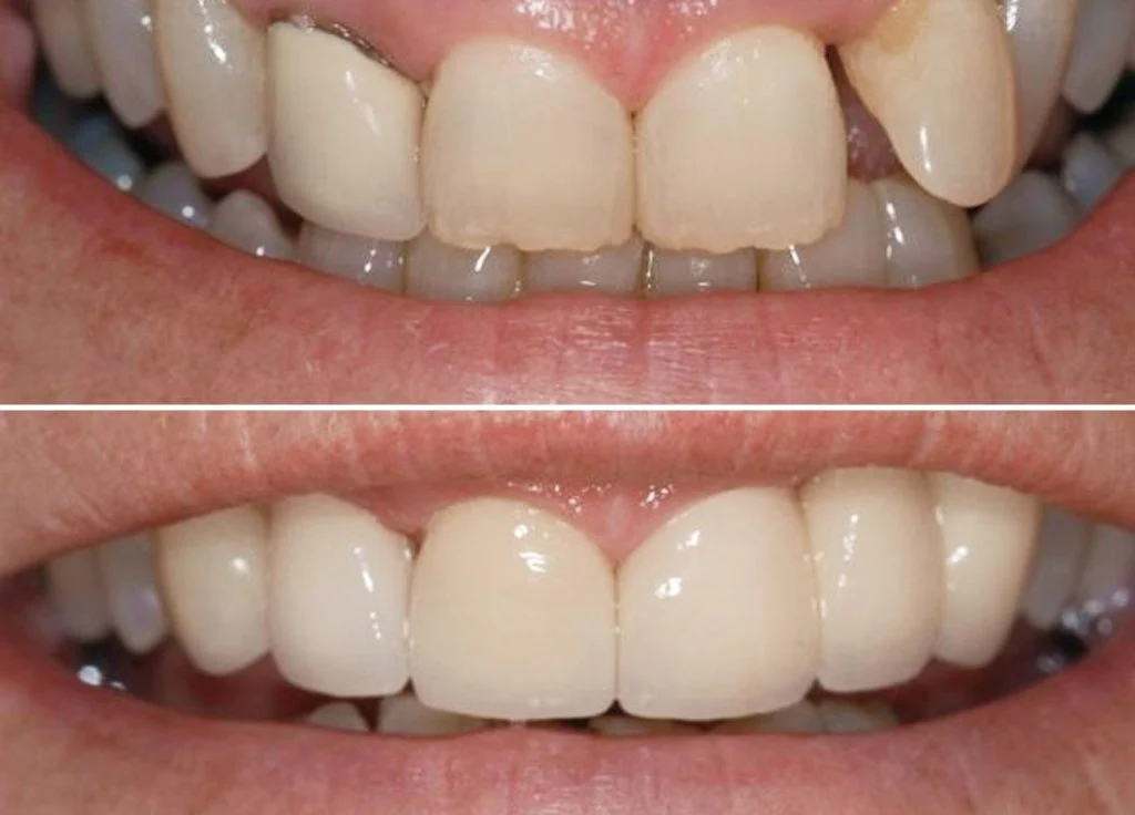 Smile Gallery Single-4