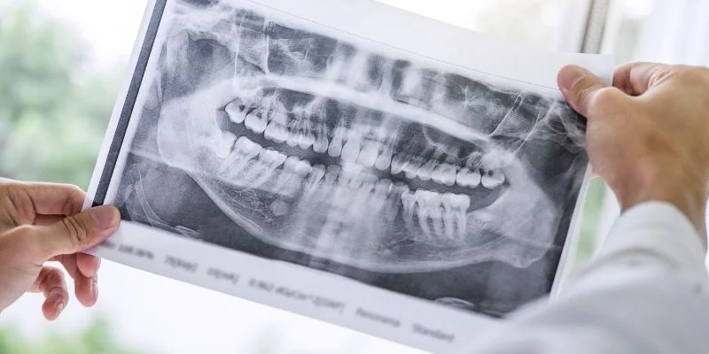 Bone Graft for Dental Implants