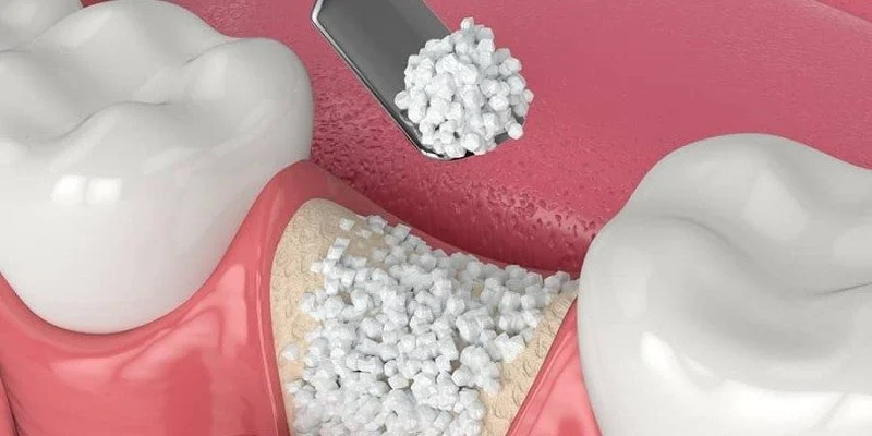 Bone Grafting Procedures for Dental Implants