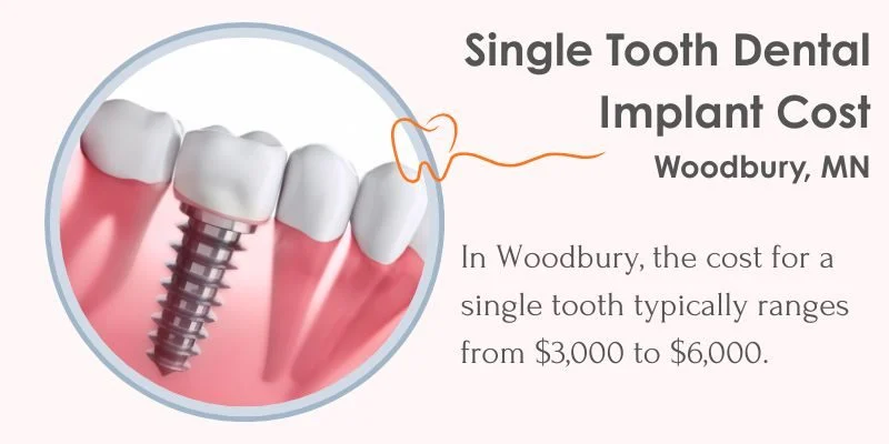 Single Tooth Dental Implant Cost in Woodbury, MN