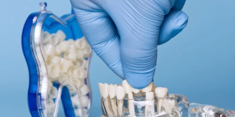 Dental Bridges vs. Implants