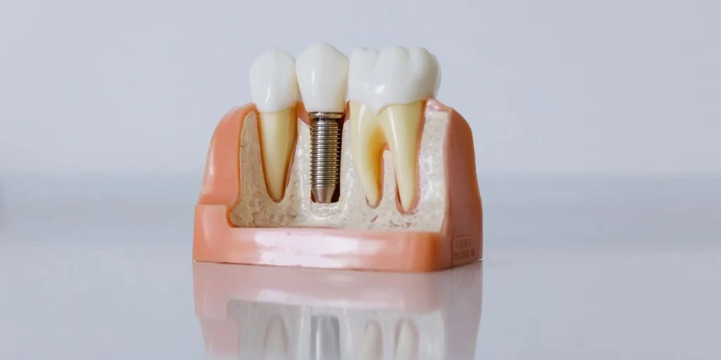 Dental Implant Procedure and Process vs. Dentures