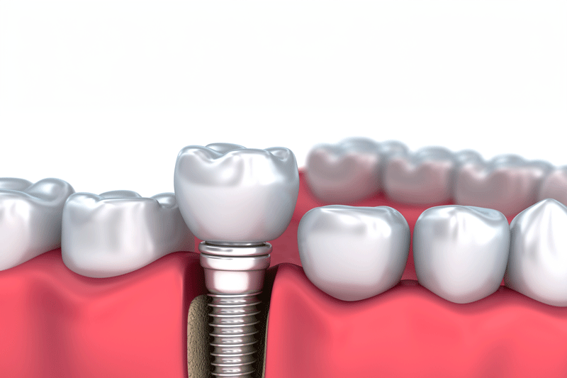 Implants3 24 2