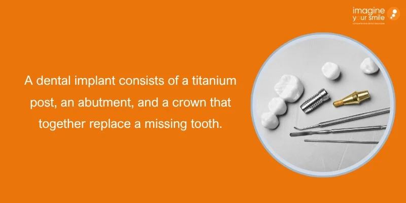 Key Components Implant, Abutment, and Artificial Tooth