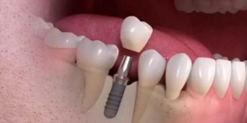 Preparatory Procedures Before Implant Placement