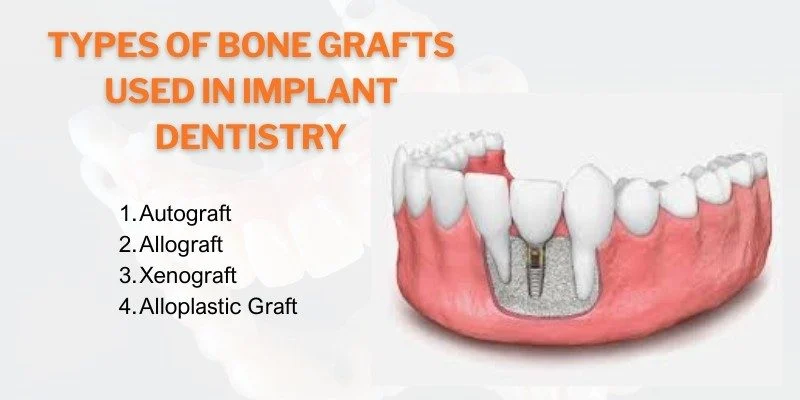 Types of Bone Grafts Used in Implant Dentistry