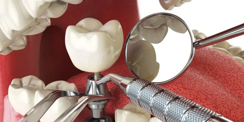 Understanding All-on-4 Dental Implants