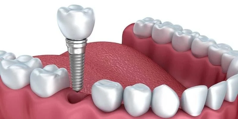 What Is a Single Tooth Implant