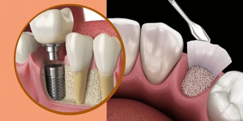 Why Bone Grafting Is Needed for Dental Implants