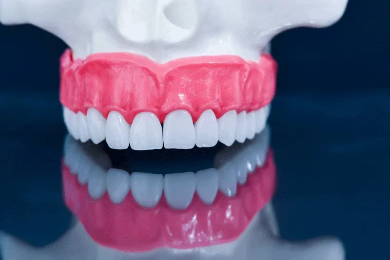 all on 4 dental implant model x