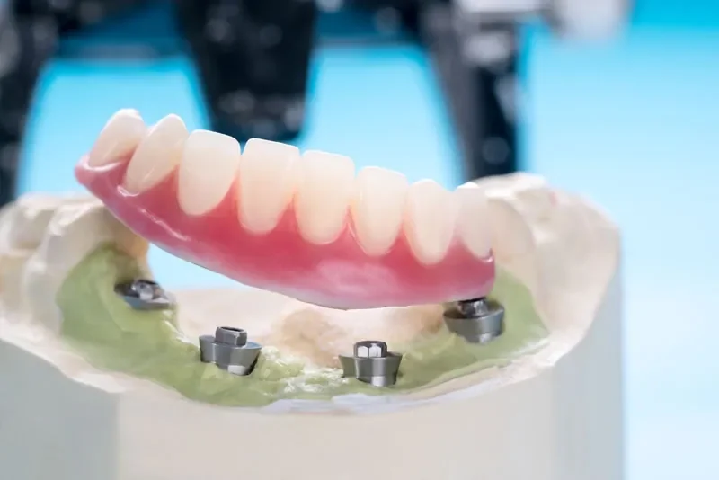 an implant supported denture model all on four implant posts