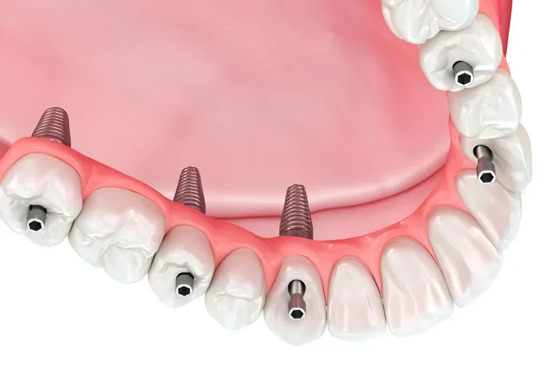 dental implant prosthetic being placed on dental implant posts