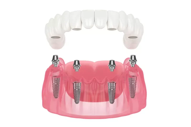full mouth dental implant prosthetic