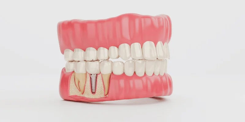 lifespan of dental restorations