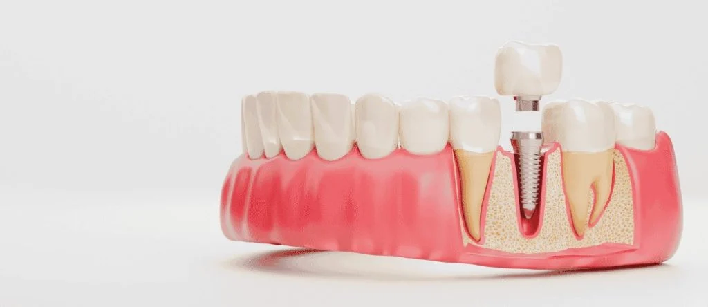 Model of a dental implant in the lower jaw