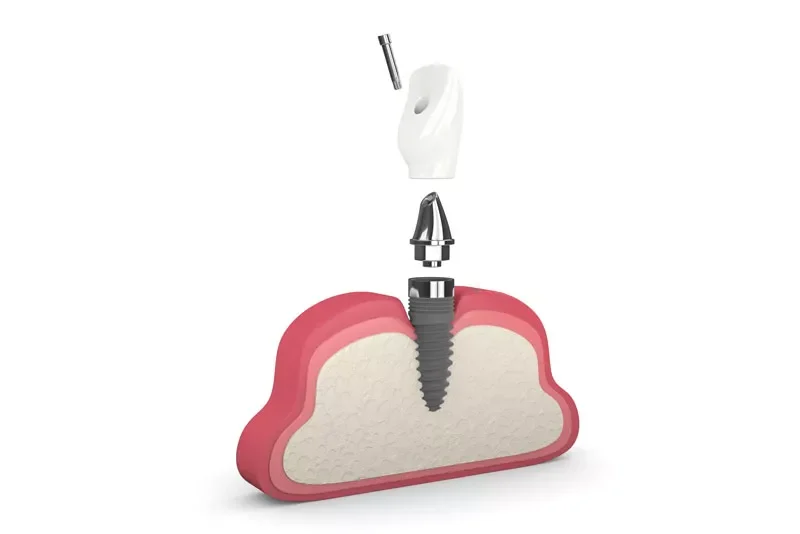 single dental implant and post