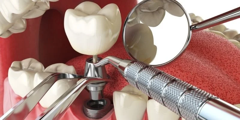 single tooth implant process