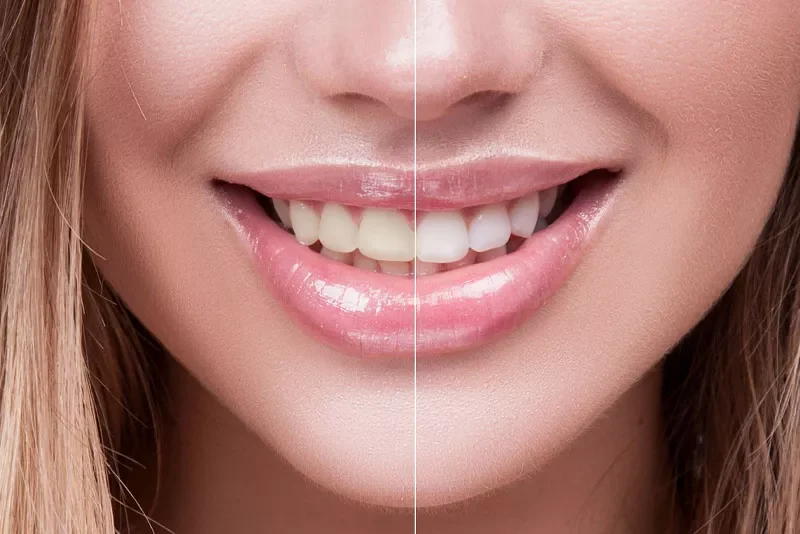 teeth-whitening-before-and-after