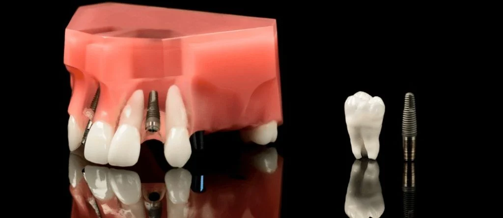 zirconia vs titanium dental implants